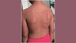 বাকেরগঞ্জে বেত্রাঘাতে শিশু শিক্ষার্থী জখম, অভিযুক্ত শিক্ষক পলাতক