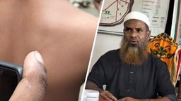 বরগুনায় প্রধান শিক্ষকের বেত্রাঘাতে আহত পঞ্চম শ্রেণির ছাত্রী, অভিভাবকদের ক্ষোভ
