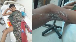 নড়াইলের কালিয়ায় বোমা সদৃশ্য বস্তু বিস্ফোরণে শিশু আহত