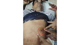 নোয়াখালীতে বিএনপি নেতাকে গুলি, লাগল সহযোগীর বুকে