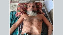 পাইকগাছায় ছয় বছর ধরে বারান্দায় শয্যাশায়ী লতিফ, অর্থাভাবে মিলছে না চিকিৎসাসেবা